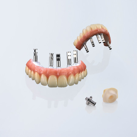 Erfahrung implantat zahn Zahnextraktion und